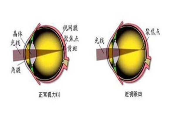 东盛堂近视恢复